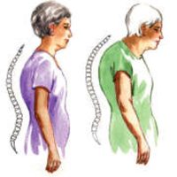 Osteoporóza