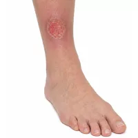 Vred na predkolení