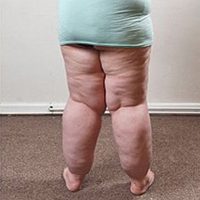 Lipoedémia - tukový edém