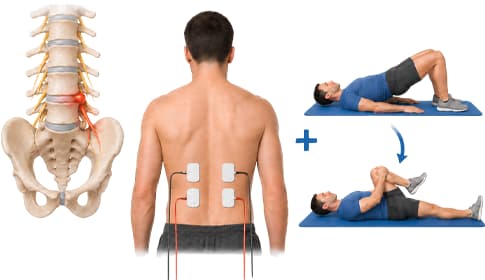 Elektrostimulácia a fyzioterapia pri rehabilitácii výhrezov platničiek