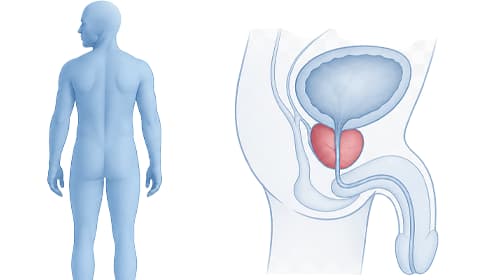 Rehabilitácia penisu po prostatektómii – protokol vakuového tréningu