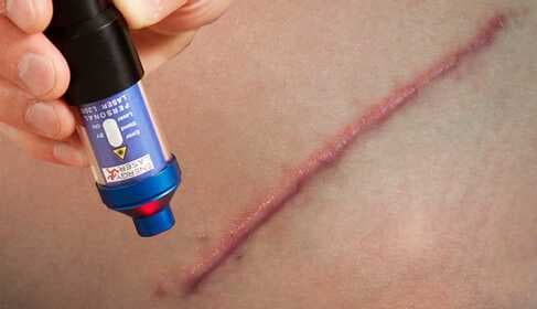 Laser terapia na jazvy a keloidy – Domáca liečba