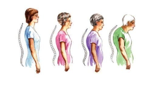 Osteoporóza a magnetoterapia – domáca doplnková liečba