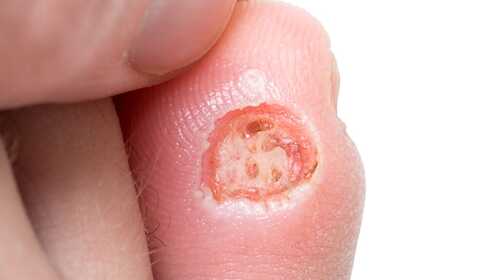 Liečba diabetickej nohy doma