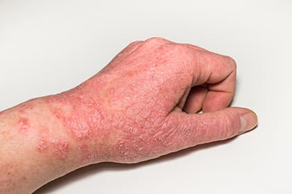Dermatologické problémy a soľná terapia – doplnková liečba ekzému a psoriázy