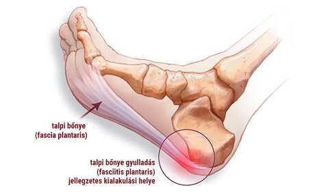 Zápal plantárnej fascie, teda plantar fasciitis