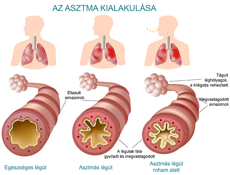 Vznik astmy a zmeny v dýchacích cestách