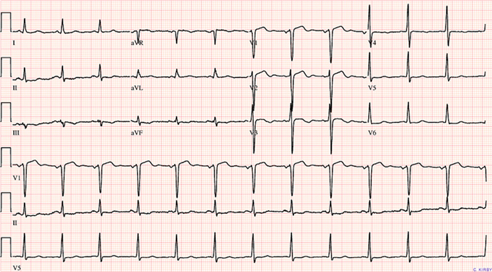 EKG-elektrokardiogram-felvetel-2.jpg
