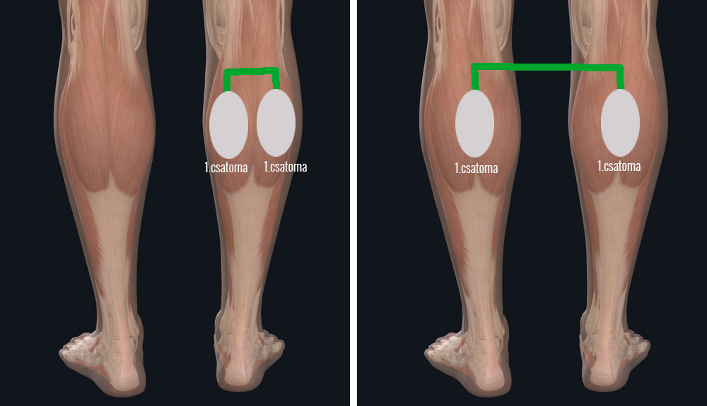 umiestnenie elektród pri terapii prístrojmi Veinoplus Arterial, Veinoplus V.I. a Veinoplus DVT