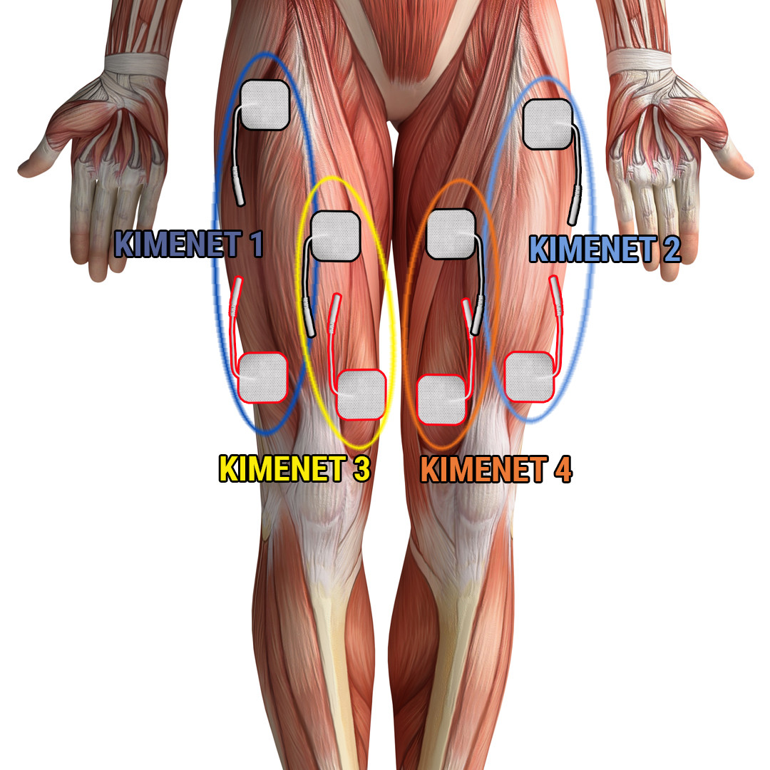 posilnenie quadriceps stimulačným prístrojom