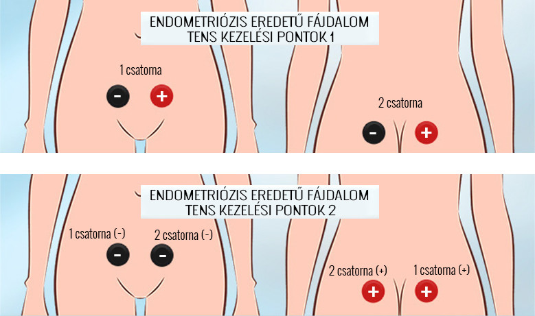 liečba endometriózy TENS, MENS liečba, umiestnenie elektród