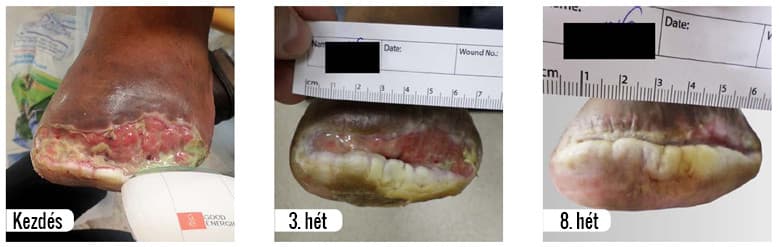 výsledok liečby vredu na nohe pomocou lágylézerového prístroja B-Cure