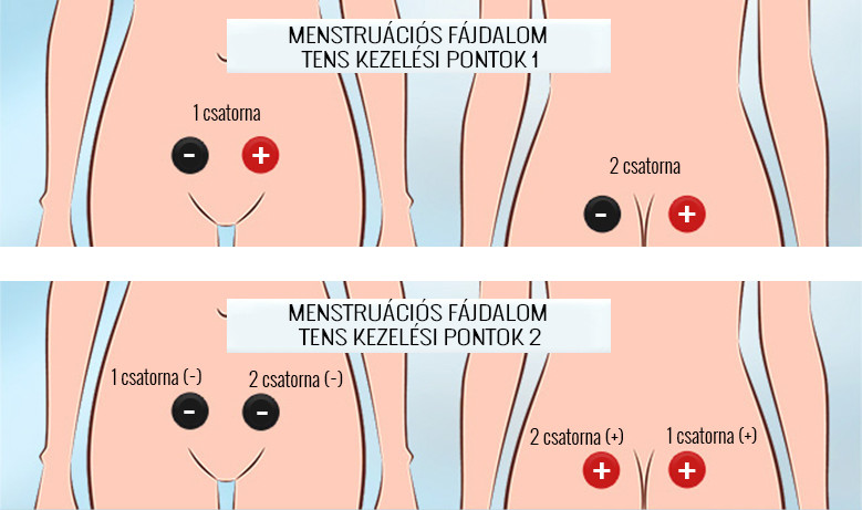 liečba menštruačných kŕčov TENS-om, body liečby