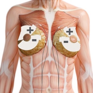 Breast-electrode.jpg